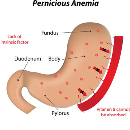 pernicious anemia panel test